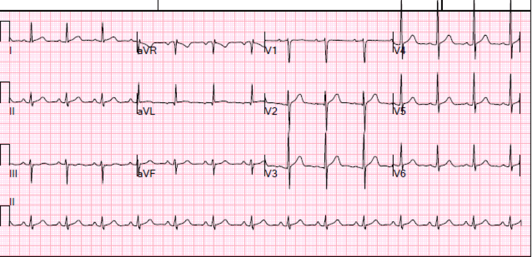 ECG mass in syncope