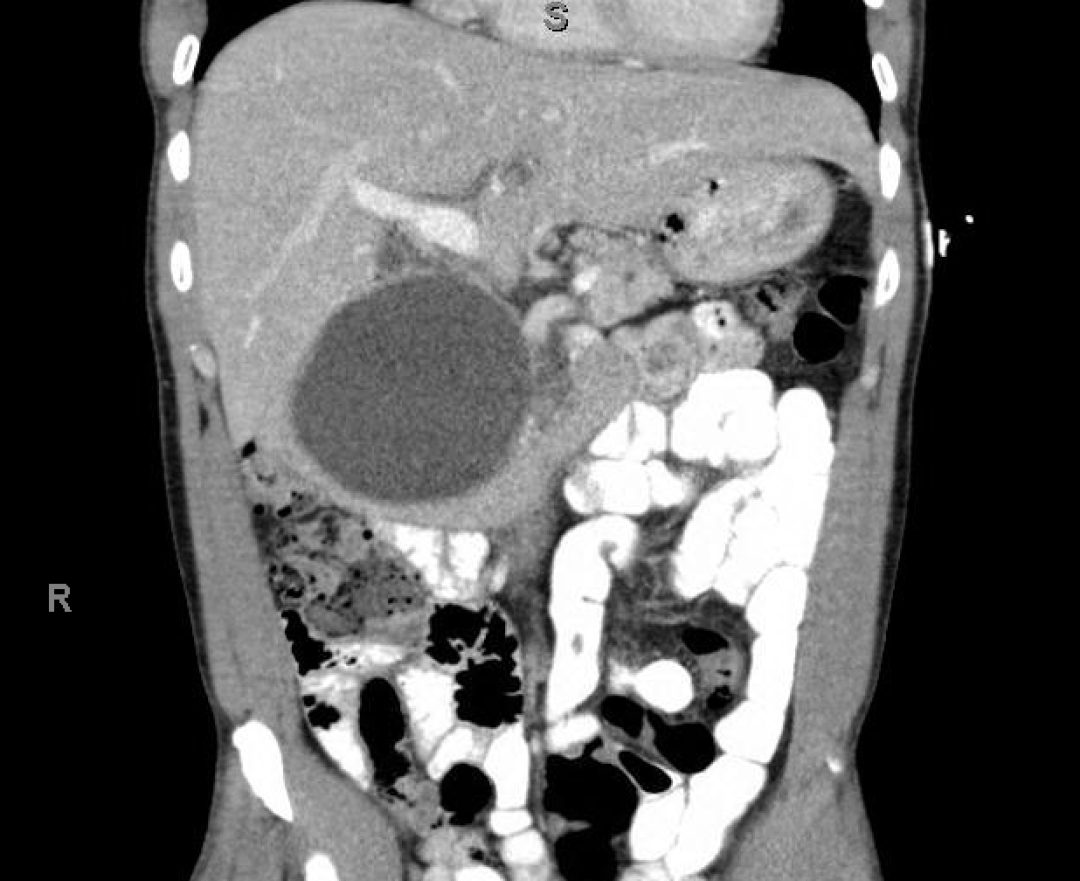 Mass in syncope CT 2