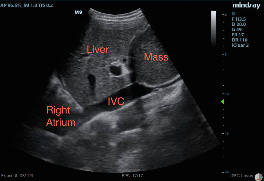 Mass compressing IVC