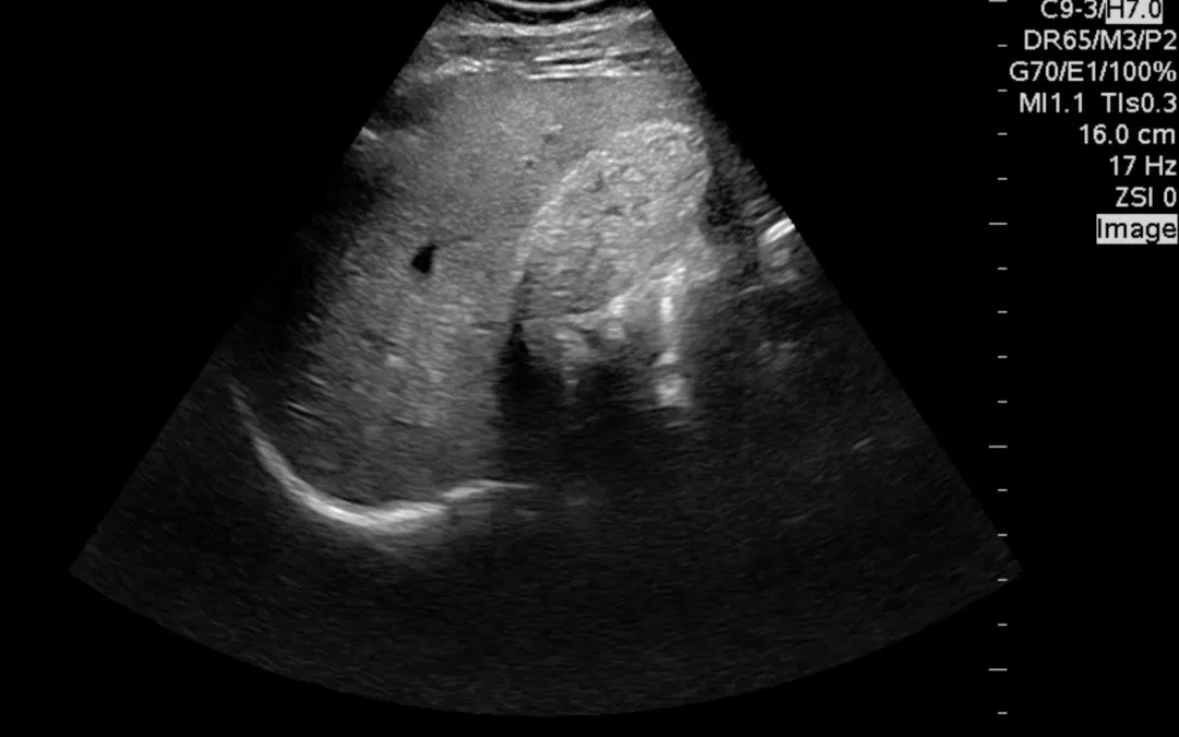 What’s causing his RUQ pain?
