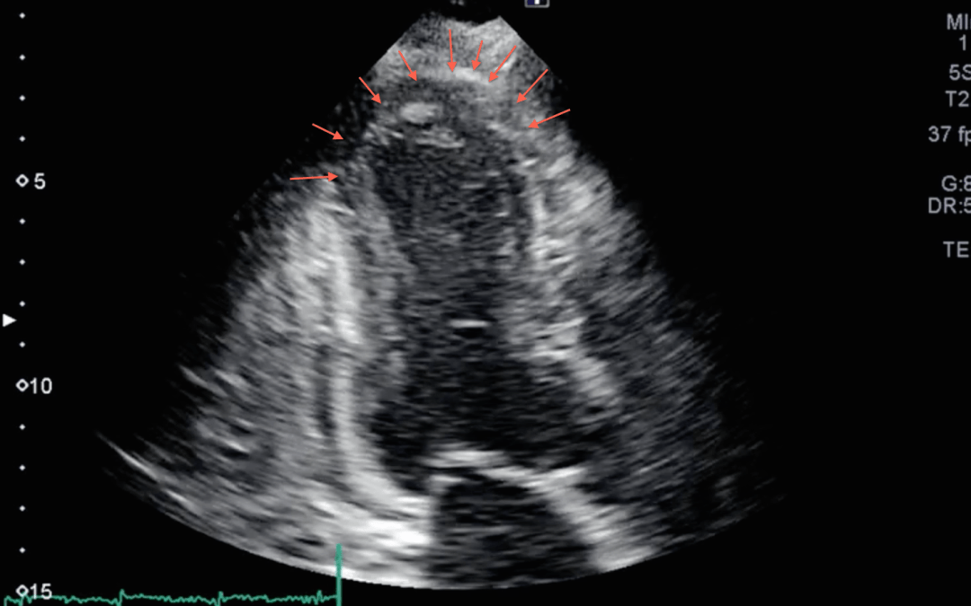 Apical Wall Motion Abnormality or Electrical Asynchrony?