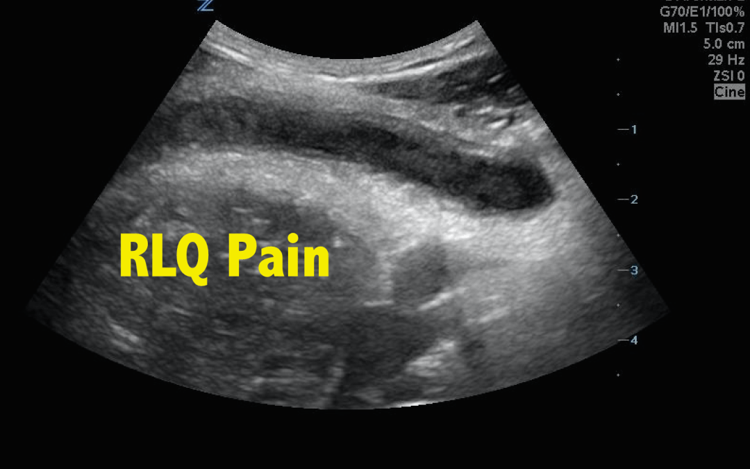 RLQ pain