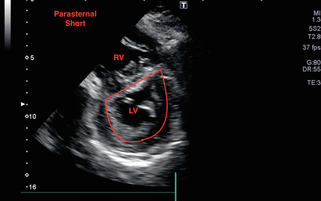 PEA Arrest: What’s the Cause?