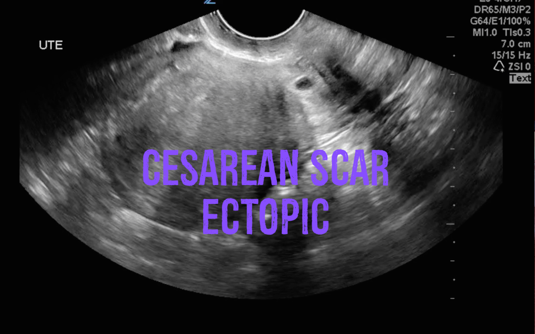 Cesarean Scar Ectopic