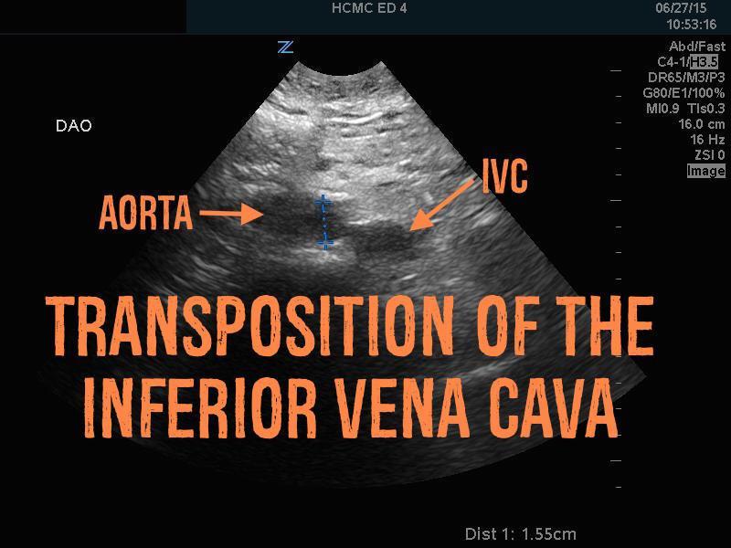 Transposition of the Inferior Vena Cava