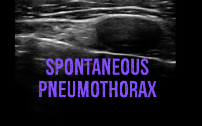 Spontaneous Pneumothorax