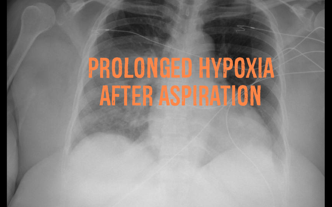 Prolonged Hypoxia After Aspiration