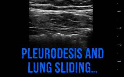 Pleurodesis and Lung Sliding…