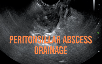 Peritonsillar Abscess Drainage