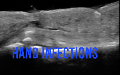 Hand Infections