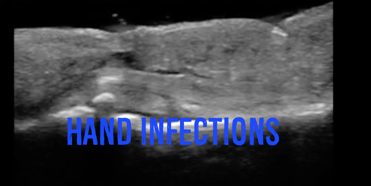 Hand Infections