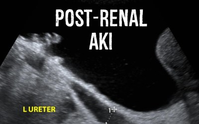 Post-Renal AKI