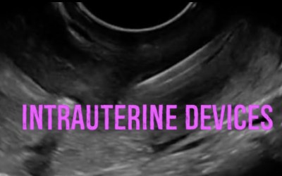 Intrauterine Devices