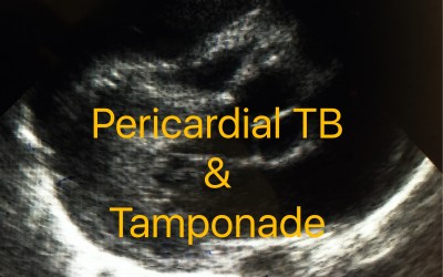 Pericardial TB with tamponade