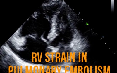 Right Ventricular Strain in Pulmonary Embolism