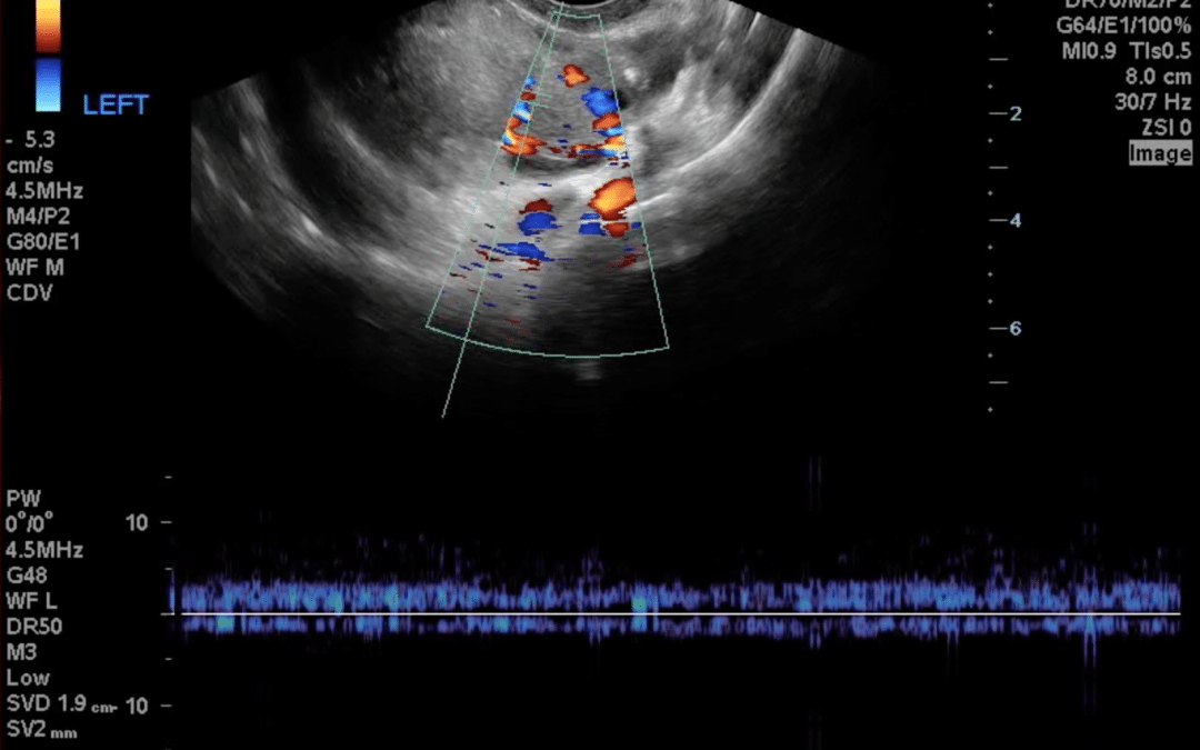 Acute Left Adnexal Pain