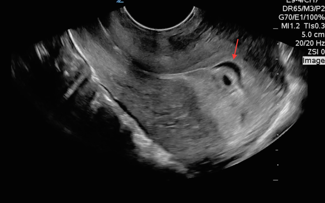 Is this fluid collection important?